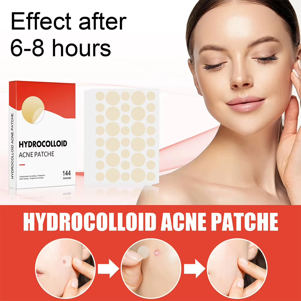 Hydrocolloid Acne Patch System: 144 Count Invisible Spot Treatment