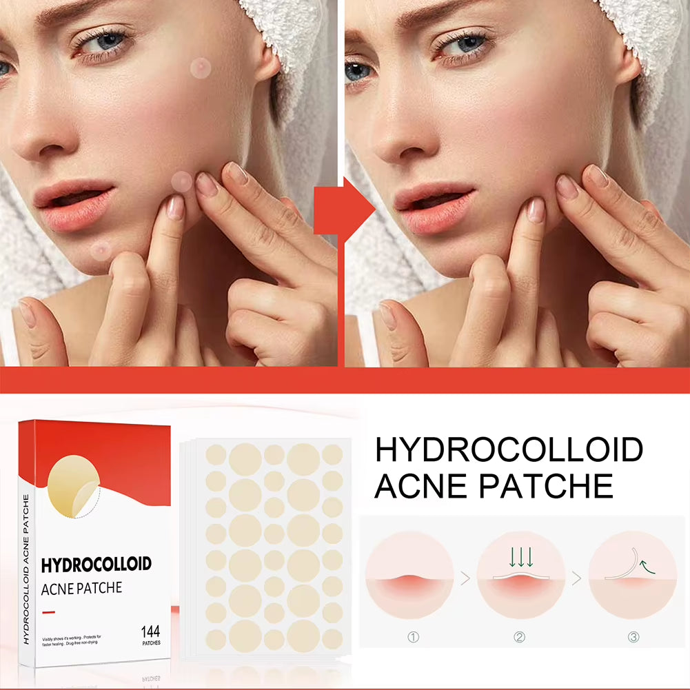 Hydrocolloid Acne Patch System: 144 Count Invisible Spot Treatment